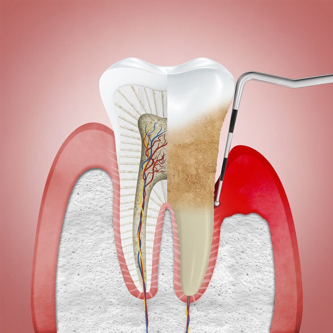 Лечение заболевшего зуба. Гингивит пародонтит периодонтит. Зондирование пародонтальных карманов.